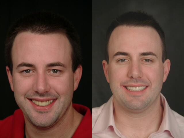 Vancouver Island Smile Makeover Vancouver Island Smile Makeover
